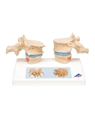 Osteoporosis Model
